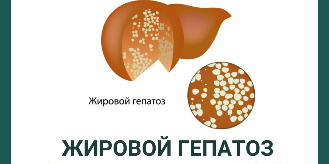 «Жировой гепатоз: как заподозрить до УЗИ»