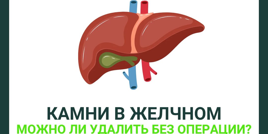 «Камни в желчном - операция не нужна? Когда можно обойтись»