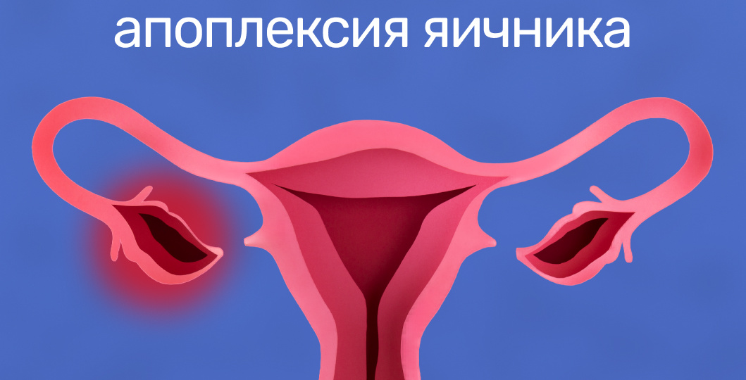 Взрыв внутри: почему случается апоплексия яичника