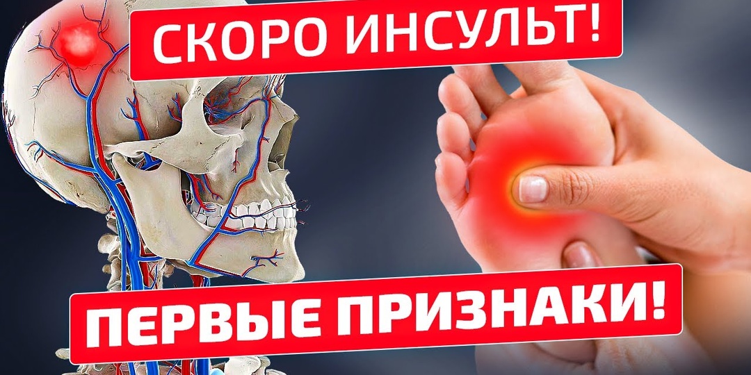 8 сигналов, указывающих на скорый Инсульт? Неврологи рассказали, как тело нас предупреждает