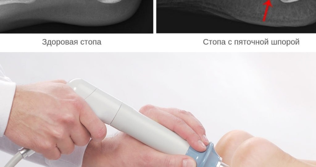 Как распознать наличие пяточной шпоры? Симптомы пяточной шпоры настолько характерны, что вы никогда не пропустите их и не перепутаете