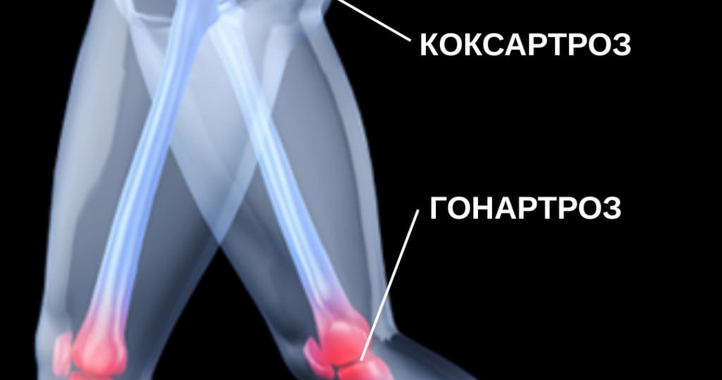 Артроз, гонартроз, коксартроз – в чём разница и почему это важно знать