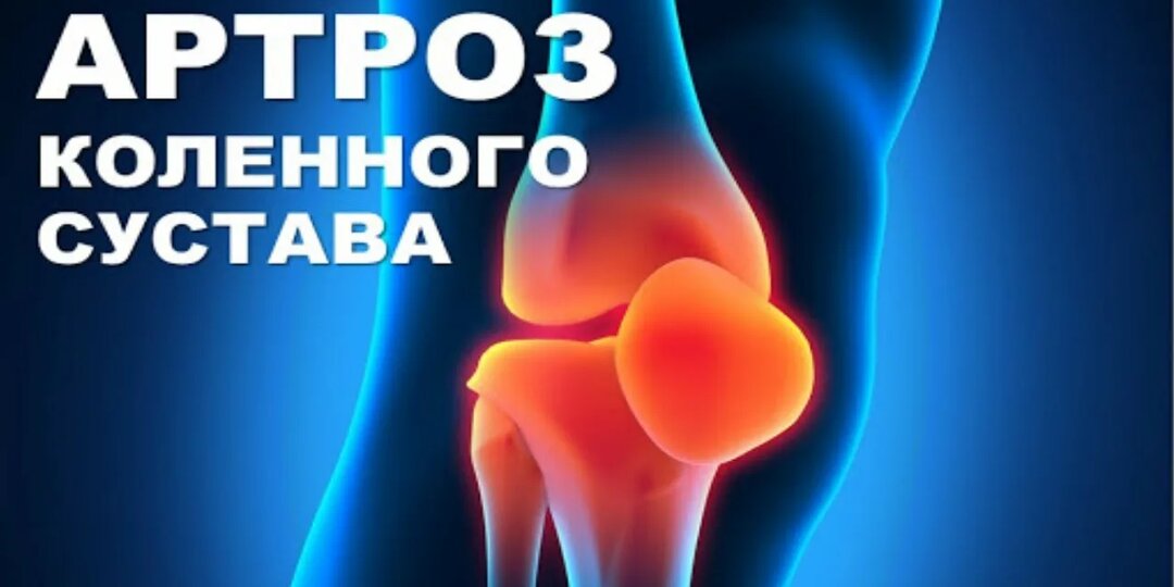 Артроз коленного сустава — лечение без операции