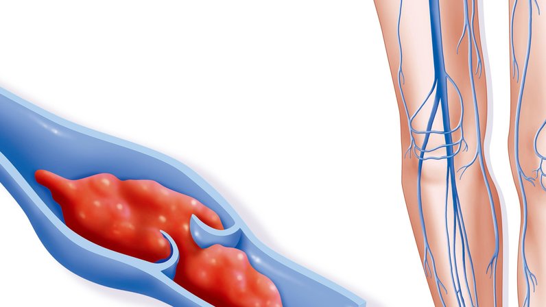 Как появляется тромб. Риск возникновения тромбоза.