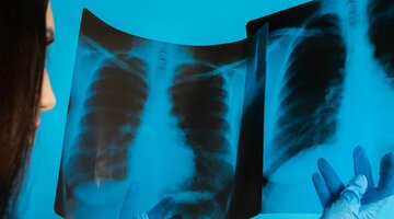 клинические формы туберкулеза периферических лимфоузлов. петербург туберкулез. туберкулез от животных. M. заболеваемость смертность туберкулез.