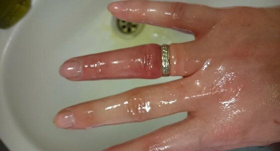 Кольцо во время беременности: древний тест, медицинский факт и скрытая опасность