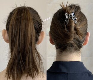 Отопластика (пластика ушей)