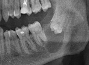 Зубы мудрости и их удаление