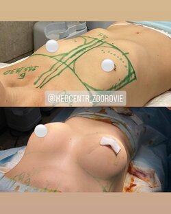 Маммопластика (пластика груди)