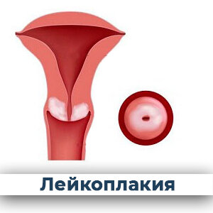 Лейкоплакия