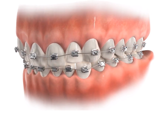 Про брекеты и прикус