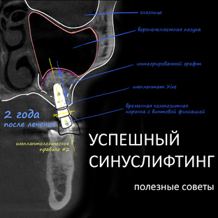 Синуслифтинг