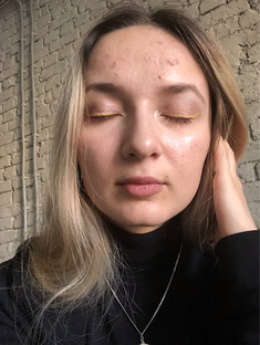 Мой личный опыт лечения акне, постакне