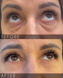 Блефаропластика (пластика век)