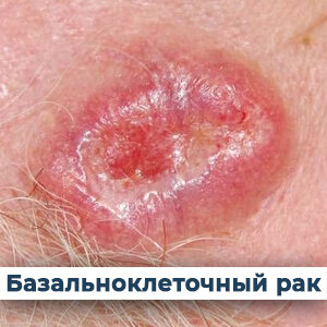 Базальноклеточный рак