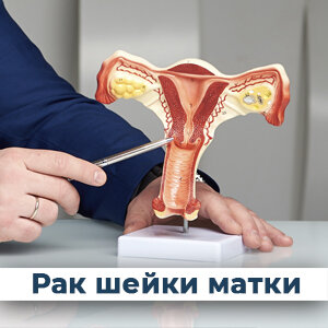 Рак шейки матки