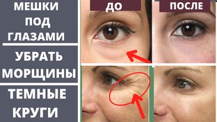 👁️Морщины вокруг ГЛАЗ. МЕШКИ под глазами. Малярные мешки