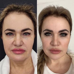 До и после. TOTAL FACE. Пластический хирург - Карапетян Георгий Эдуардович