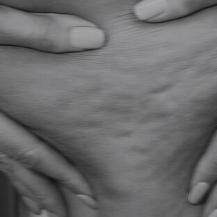 Про целлюлит 