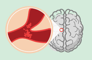 Геморрагический инсульт