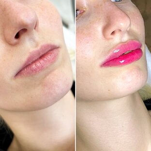 Увеличение губ 