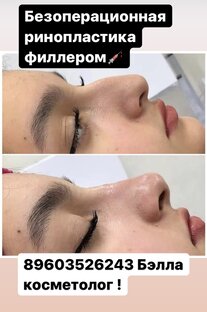 Безоперационная ринопластика 💉