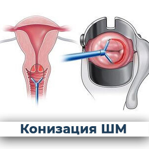 Конизация шейки матки