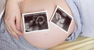 Про мое бесплодие, ЭКО, и беременность двойней