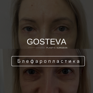 Блефаропластика . Подтяжка лица 