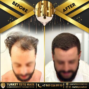 Пересадка волос в Москве