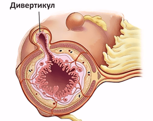 Дивертикулы
