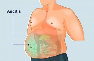Осложнения/лечение/последствия
