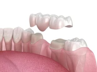 Протезирование зубов
