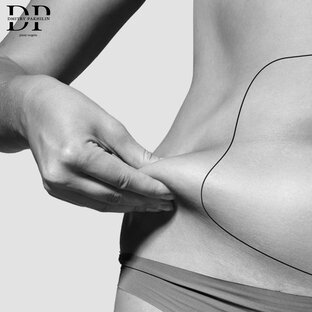 Абдоминопластика 