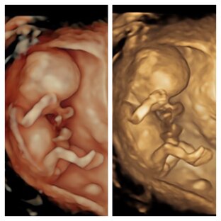 Первый скрининг