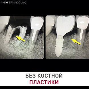 БЕЗ КОСТНОЙ ПЛАСТИКИ