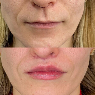 Булхорн (пластика верхней губы)