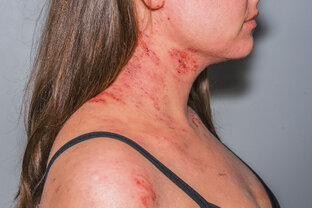 Атопический дерматит 