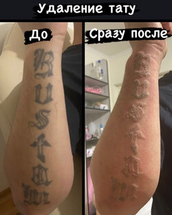 Удаление тату