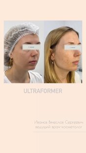Ultraformer(ульраформер)