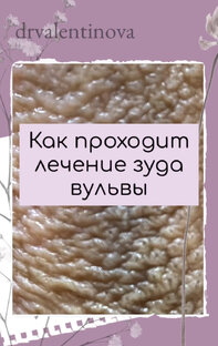 Лечение зуда вульвы. Крауроз вульвы(САЛВ)