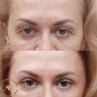 Блефаропластика