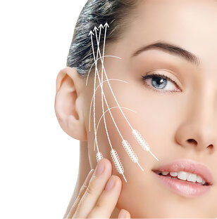 Нитевой лифтинг