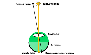 Чёрная точка на макуле глаза!