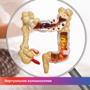 Виртуальная колоноскопия