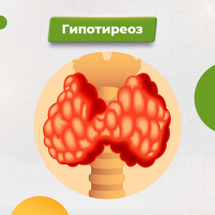 ВСЕ СТАТЬИ О ГИПОТИРЕОЗЕ