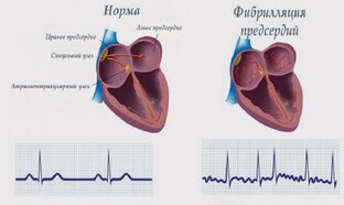 ФИБРИЛЛЯЦИЯ ПРЕДСЕРДЦИЙ
