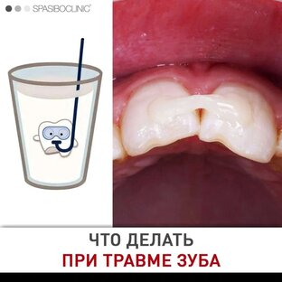 ТРАВМА ЗУБА 