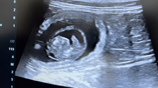 УЗИ плода
