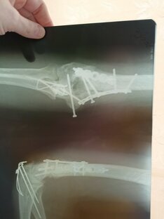 Перелом и беременность